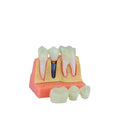 4 Times Dental Education Studying Plastic Dental Implant Model for Education Tooth Multi-Purpose Teeth Whitening Accessories