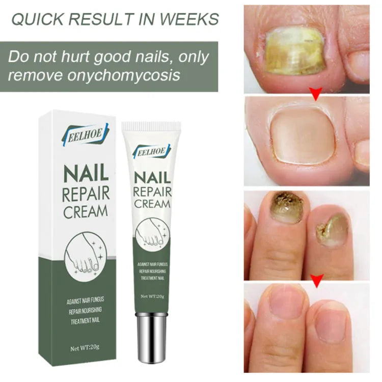 OEM/ODM Private Label Fungal Nail Treatment Easy to Use Lightweight Skin Friendly Fungus Removing Nail Repair Cream for Foot