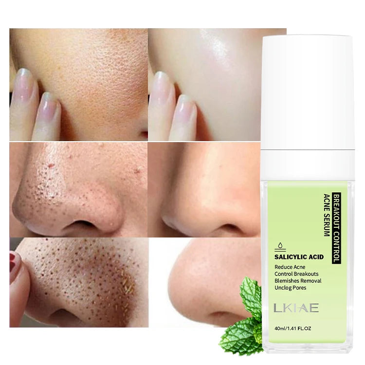 OEM ODM Best Control Acne Inhibit Breakouts Unclog Repair Pores Salycilic Acid Anti-Acne Skin Care Face Serum