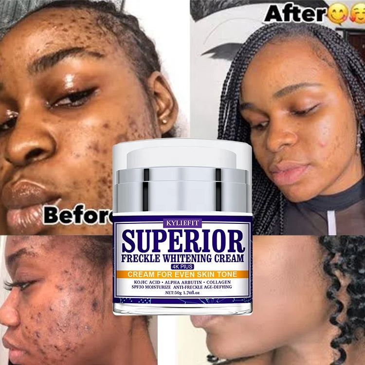 KYLIEFIT Anti Freckle Whitening Deep Moisturizing Removal Dark Spot Corrector Skin Anti Aging Remover Face Cream