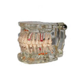 Dental Pathology Model with Half Implant Studying Dental Human Teeth Medical Science Education Model